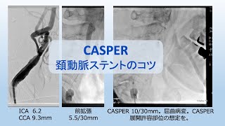 CASPER 頚動脈ステント留置（CAS）のコツ [upl. by Leeanne716]