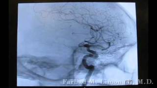 3D Cerebral Angiography [upl. by Bilicki881]