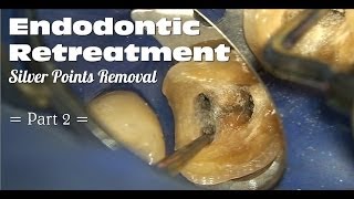 Endodontic Retreatment  Silver Points Removal Part 2 [upl. by Debbee]