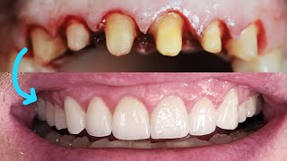 Front Tooth Crowns Before amp After Cosmetic Dentist Smile Makeover EMAX Preparation Remove Veneers [upl. by Akeenahs]