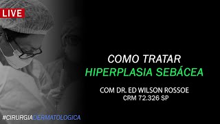 COMO TRATAR HIPERPLASIA SEBÁCEA  DR ED WILSON ROSSOE  CIRURGIA DERMATOLÓGICA [upl. by Stover263]