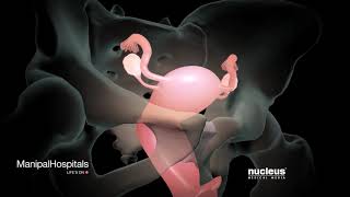 How Is A Robotic Hysterectomy Done  Robotic Hysterectomy Surgery  Gynaecology  Manipal Hospitals [upl. by Thynne]