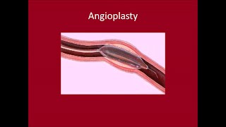 Angioplasty [upl. by Langill]