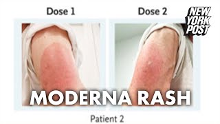 Side effect of Moderna vaccine may be a delayed skin rash doctors warn  New York Post [upl. by Claudianus157]