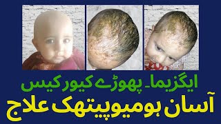 Cure Case  Eczema  Abscesses  ہومیویتھک علاج [upl. by Tymothy]