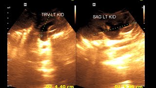 Bilateral hydro nephrosis  Bilateral dilated ureter  Renal Ultrasonography [upl. by Jaqitsch277]