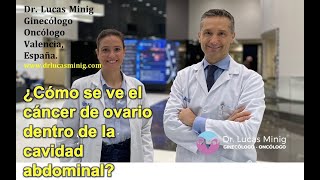 👍 ¿Cómo se ve el cáncer de ovario dentro de la cavidad abdominal Dr Lucas Minig Valencia España [upl. by Deeas393]