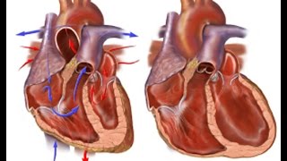 Congestive Heart Failure [upl. by Llenrac]