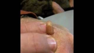 Man Squeezes Botfly from Hand [upl. by Aelam]