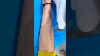 Laser treatment for lichen Planus Pigmentosus Treatment  Skinaa Clinic viral viralshort [upl. by Yurik]