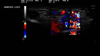 Dactylitis ultrasound [upl. by Metcalf]