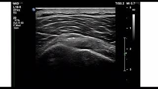 Subacromial subdeltoid bursa injection [upl. by Yhtorod]