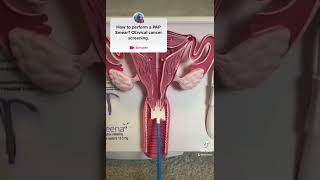 PAP Smear demonstration for Cervical cancer screening MEDICAL TIPS [upl. by Pride]