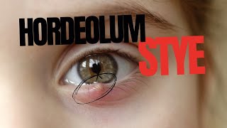 Stye Hordeolum [upl. by Noakes]