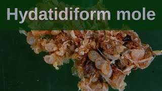 Complete Hydatidiform Mole  Pathology mini tutorial [upl. by Eanej]