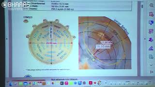 Plaque brachytherapy for intraocular tumors [upl. by Lytsirhc840]