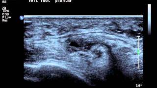 intermetatarsal bursa ultrasoundavi [upl. by Onitsirc]