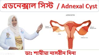 এডনেক্সাল সিস্ট । Adnexal Cyst । হোমিওপ্যাথিক চিকিৎসা। ডাঃ শামীমা নাসরীন দিনা । [upl. by Atnuahsal]