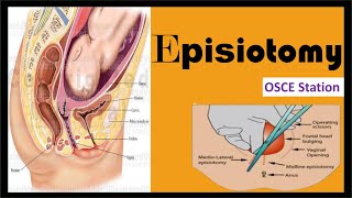 Episiotomy  Types Procedure Indications and Complications [upl. by Hortense263]