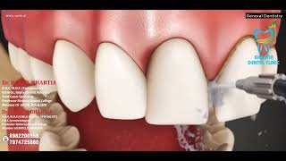 Does a Water Flosser Work A Dentist Explains [upl. by Riaj97]