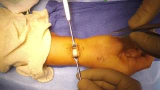 First Extensor Compartment Release for deQuervains Tenosynovitis [upl. by Thevenot690]