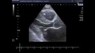 Mitral Valve Prolapse Barlow disease [upl. by Adnohsal]