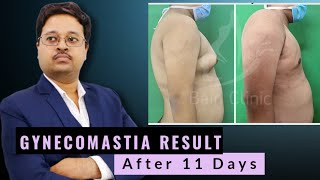 Gynecomastia Result After 11 days By Dr Jayanta Bain plastic amp cosmetic surgeon [upl. by Asylem]