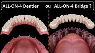 All on 4  Type de prothèse  Dentier ou Bridge [upl. by Quinlan]