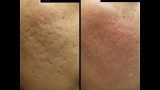 Acne Scar Laser Surgery⚡️ [upl. by Hebe]