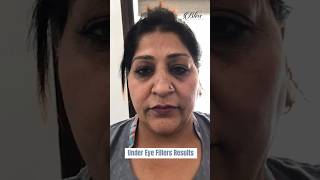 Under eye filler before and after  Dr Shikha Aggarwal  Dermal Fillers Treatment in Ludhiana [upl. by Amerak95]