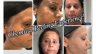 How To Get Rid Of Pigmentation On Face Chemical Peeling  Melasma  Skin discolouration [upl. by Lerad]