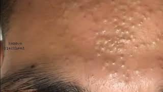 Forehead Acne amp Blackhead Treatment  Blackhead Removal on forehead removeblackhead [upl. by Stent]