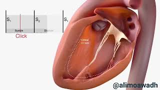 Mitral valve prolapse [upl. by Ricki]