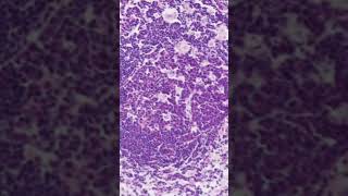 Toxoplasma Lymphadenitis Histology [upl. by Jansson]