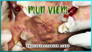 Big Cystic Acne Blackheads Extraction Blackheads amp Milia Whiteheads Removal Pimple Popping [upl. by Anelaj]