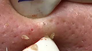 Big Open amp Closed Blackheads Removal  The best Pimple Popping Videos [upl. by Lozar]