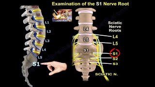 Examination Of S1 Nerve Root  Everything You Need To Know  Dr Nabil Ebraheim [upl. by Mukund]