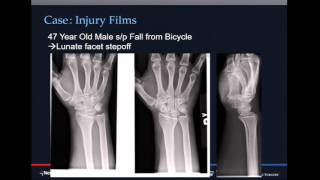 Comminuted intraarticular distal radius fractures  when to fix span or close reduce [upl. by Daisy]