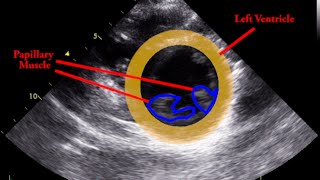 Papillary Muscle  Parasternal Short Axis [upl. by Lehcir940]