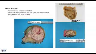 Skin  Pilomatrixoma Gross pathology [upl. by Moretta]