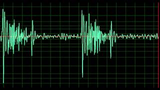 Hypertrophic Cardiomyopathy normal speed [upl. by Dorwin620]