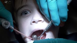 DENTAL HEALTH VLOG  HIS FIRST CAVITY FILLING  TWO CAVITIES [upl. by Eugeniusz]