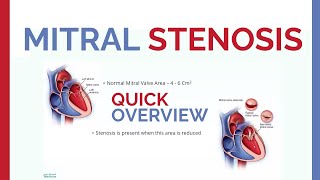 Mitral Stenosis  Overview amp Revise [upl. by Alliuqat]