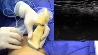 UltrasoundGuided Femoral Nerve Block [upl. by Lipinski237]