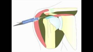 Acromioplastie arthroscopique de lépaule pour tendinite [upl. by Standish377]