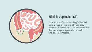 Appendicitis Symptoms Causes Diagnosis and Treatment  Merck Manual Consumer Version [upl. by Eeryn]