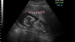 15 week ultrasound Its a GIRL [upl. by Neesay]