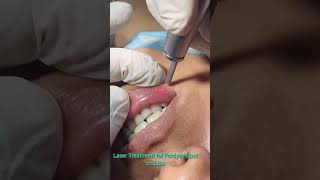 Laser treatment for Fordyce spot on lips [upl. by Yc866]