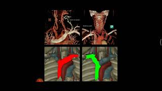 COMO FAZER ANGIOTOMOGRAFIA DE CAROTIDAS [upl. by Herta95]