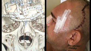 BRAIN SURGERY CYBORG SANTOS 7 HOUR SKULL CRUSHING SURGERY METAL PLATE IN HEAD VS MICHAEL PAGE [upl. by Eustache457]